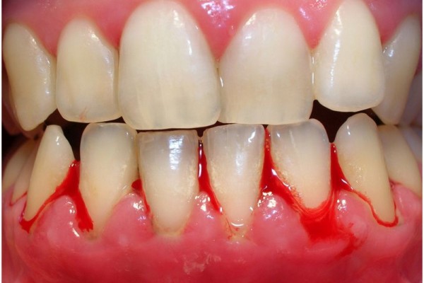 Periodontal disease